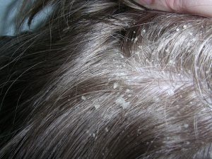 cure dandruff