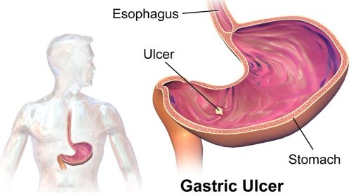 Gastric Ulcer