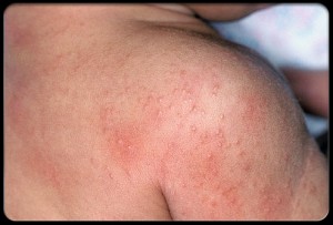 Causes of prickly skin
